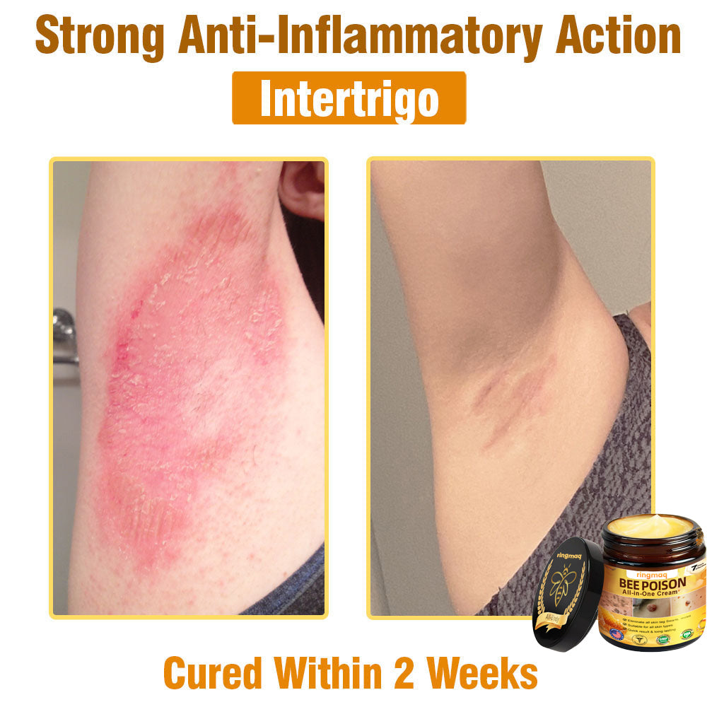 ringmaq Bee Poison All-in-One Cream US Dermatologist Approved