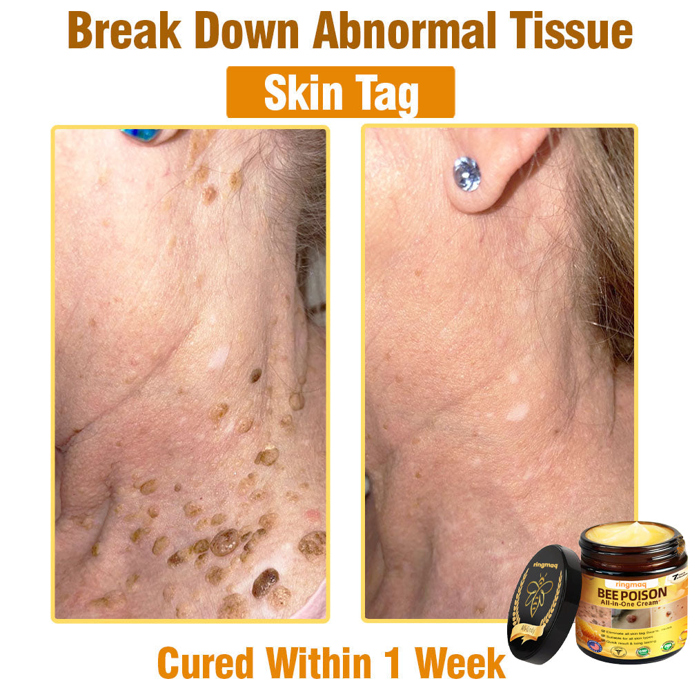 ringmaq Bee Poison All-in-One Cream US Dermatologist Approved