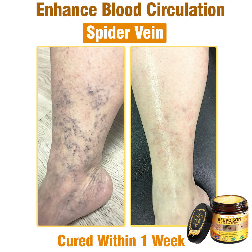 ringmaq Bee Poison All-in-One Cream US Dermatologist Approved